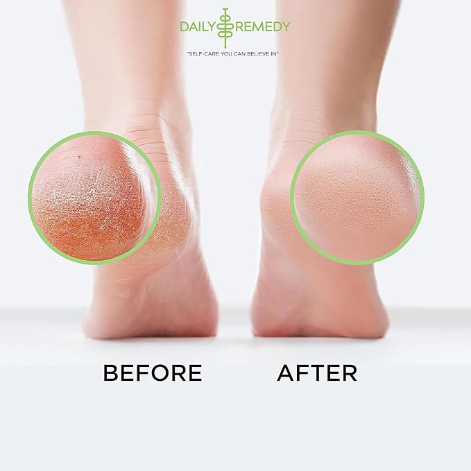 Tea Tree Oil Foot Soak with Epsom Salt - Made in USA - for Toenail irritations, Athletes Foot, Stubborn Foot Odor Scent, Softens Calluses & Soothes Sore Tired Feet - 2 Pack